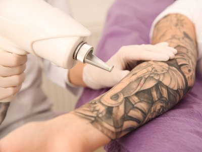 Remoción de Tatuajes